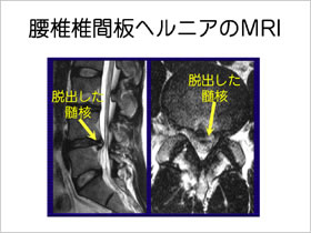 椎間板ヘルニアのMRI