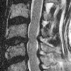 頸部脊柱管狭窄症