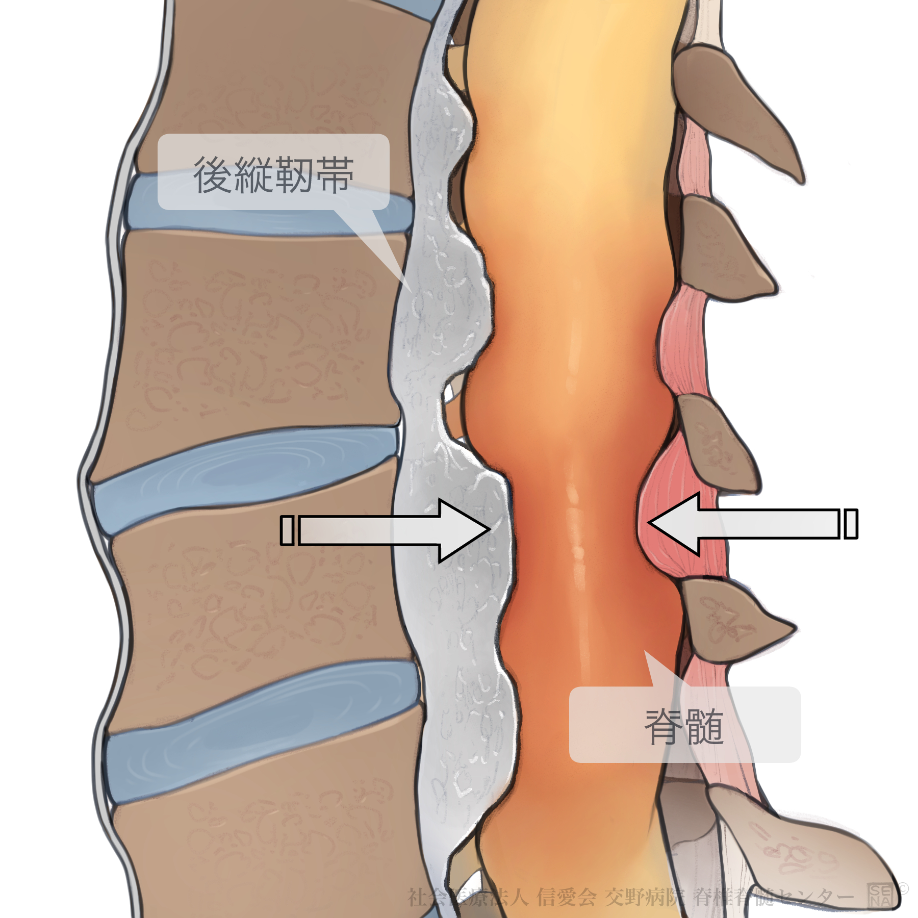 頸部脊柱管狭窄症