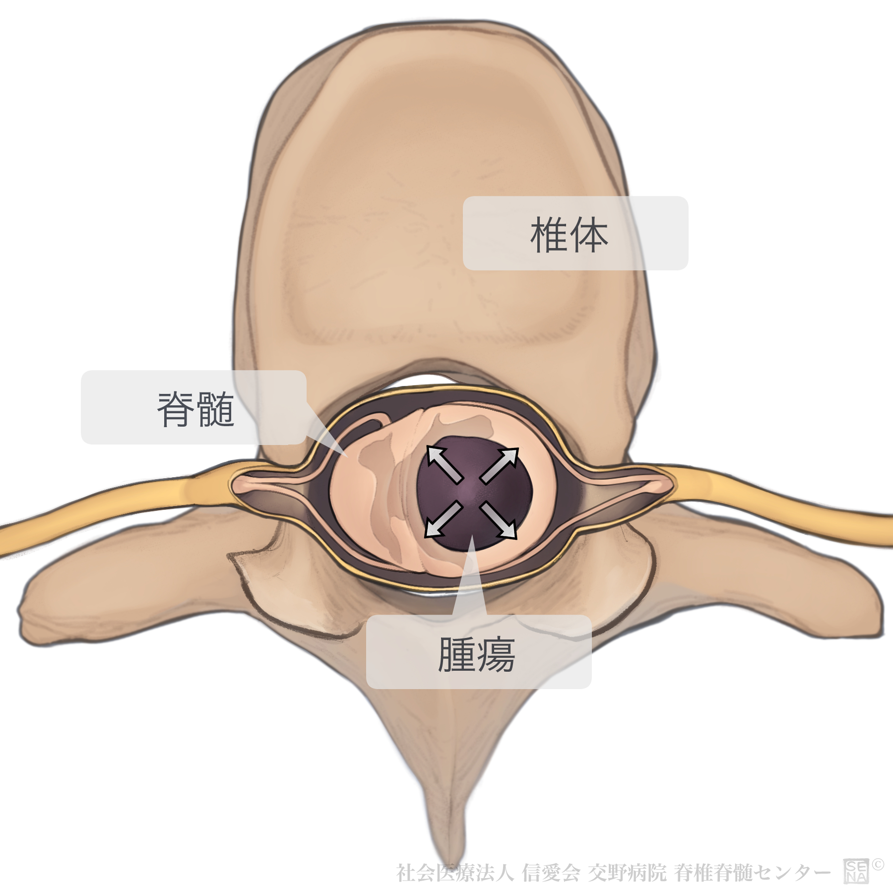 硬膜内髄内腫瘍