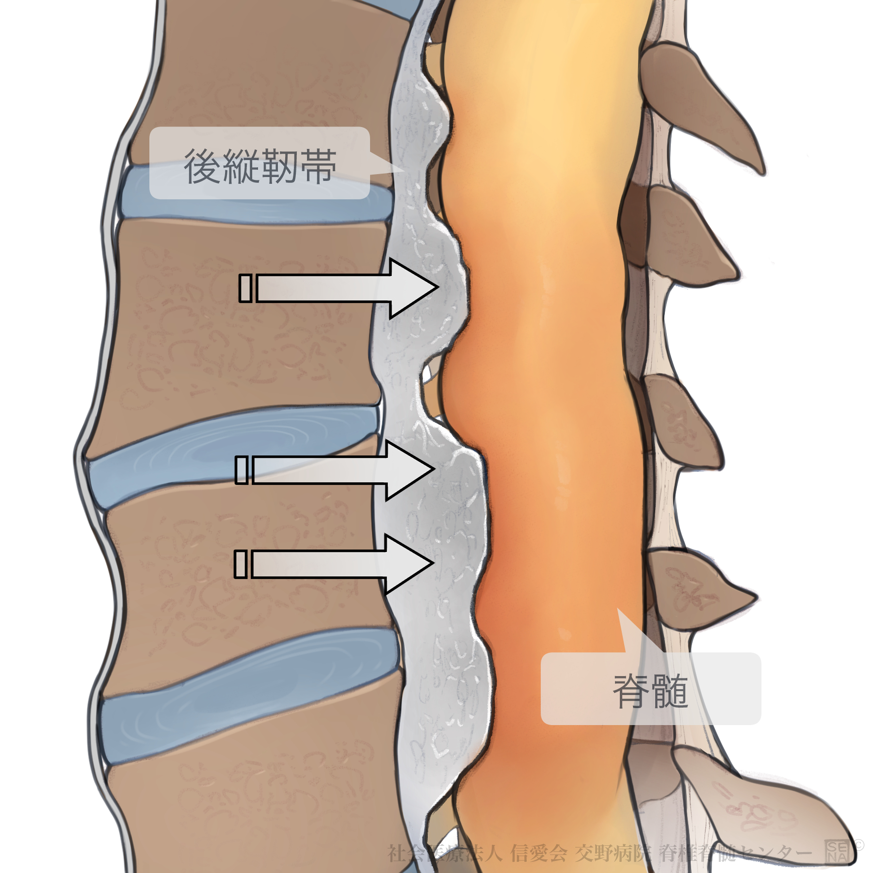 腰椎すべり症