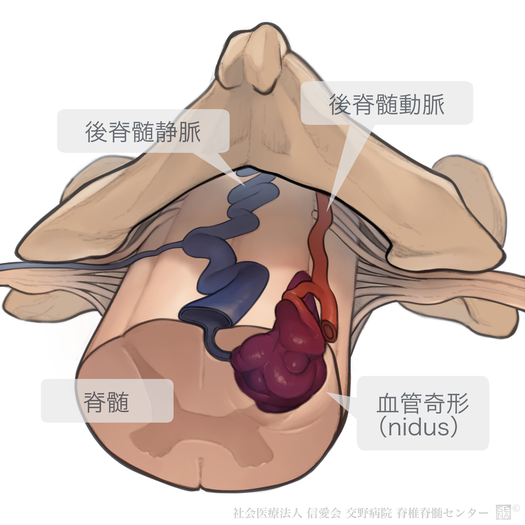 海綿状血管腫