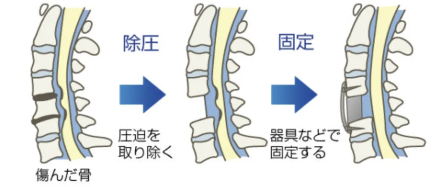 頚椎前方固定術