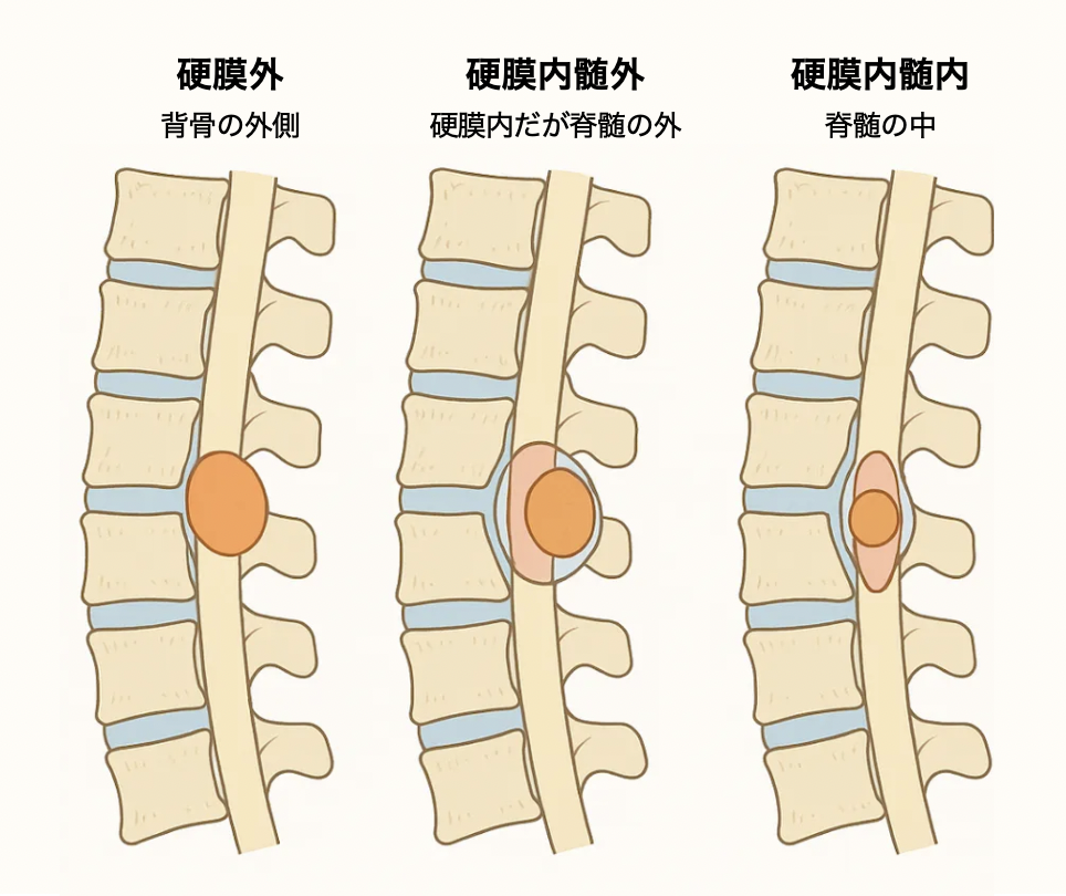 硬膜外血腫