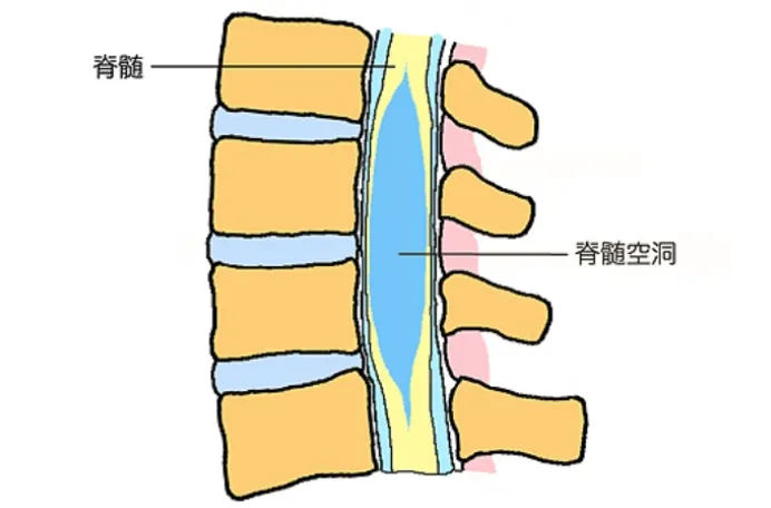 脊髄空洞症