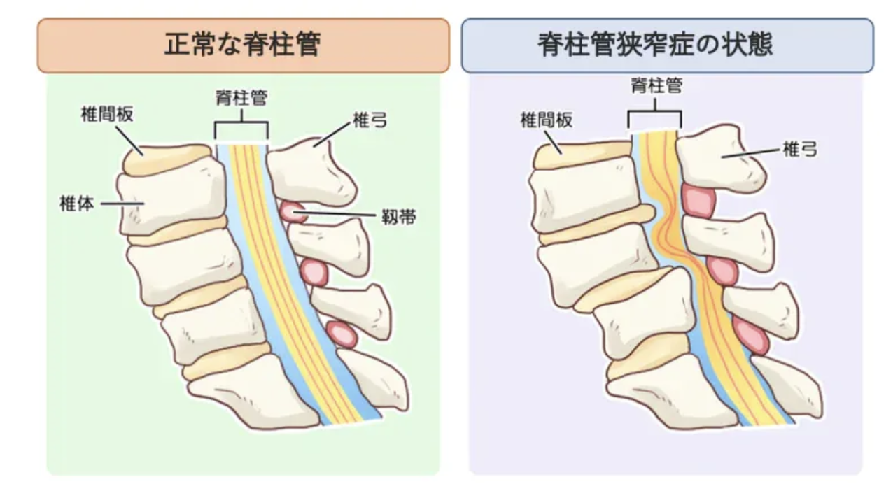 脊柱管狭窄症