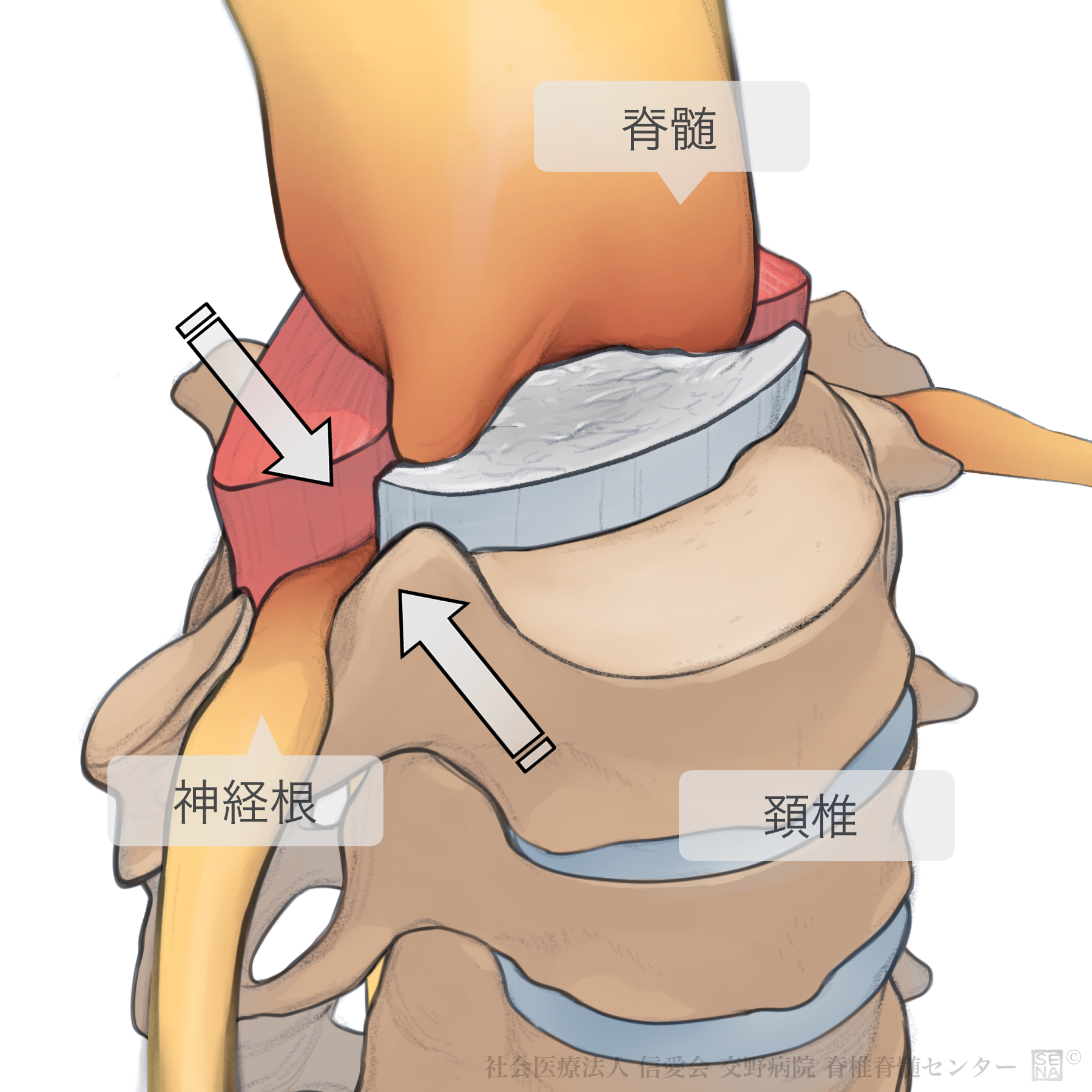 神経根障害