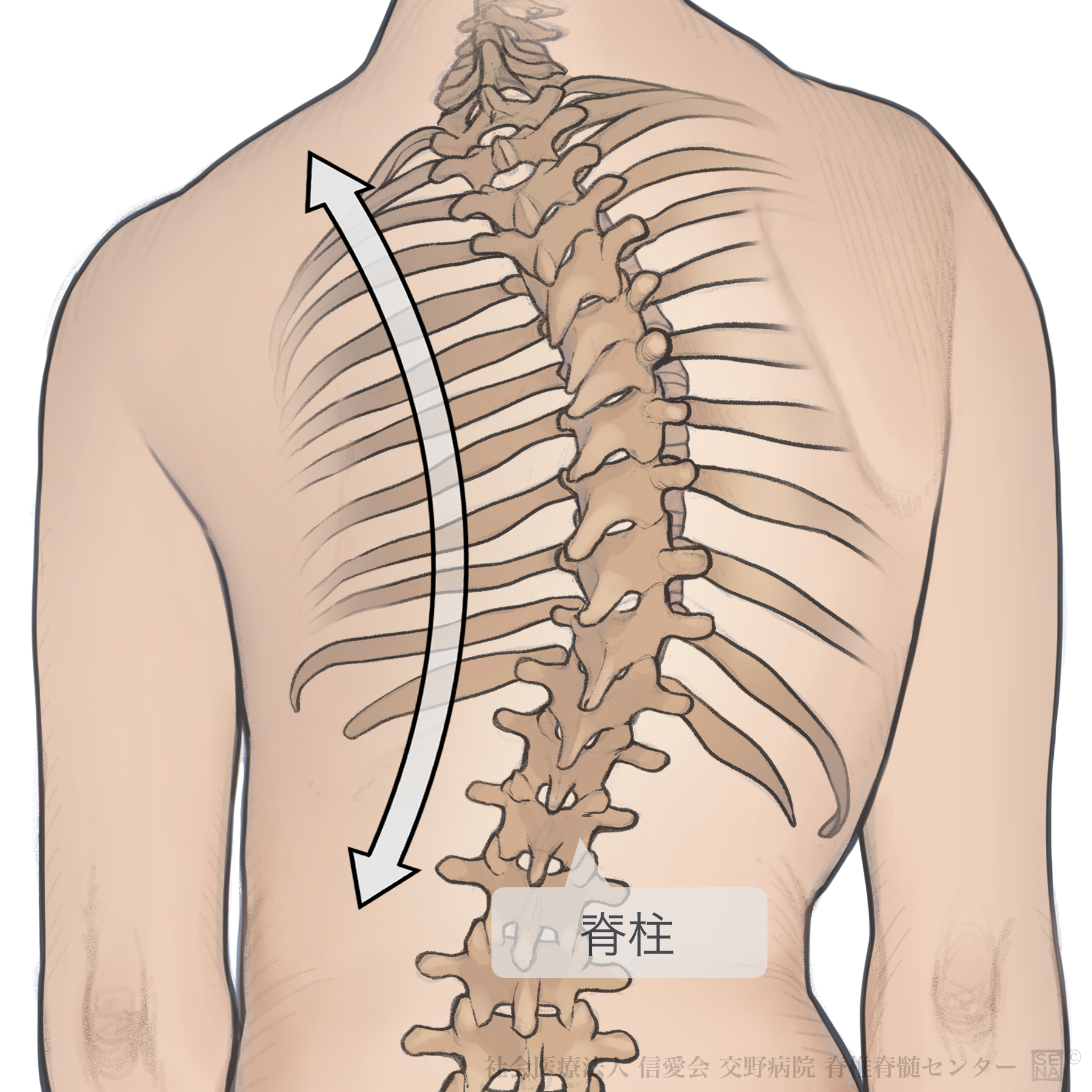 脊髄側弯症